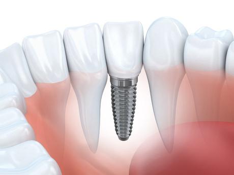 Dental Implants Oklahoma City, OK