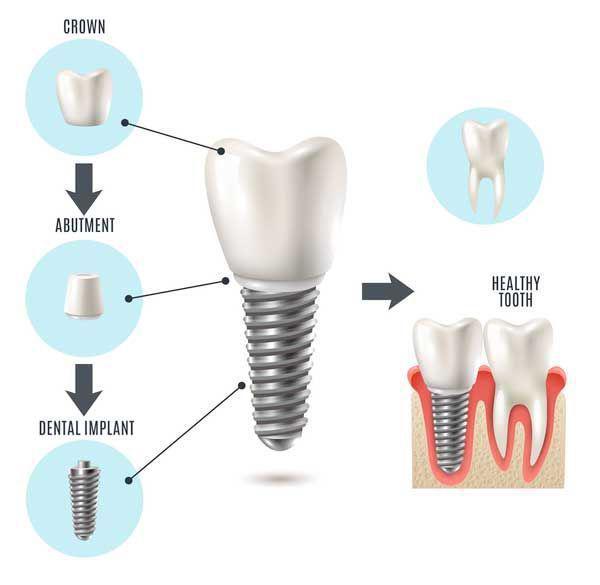 Dental Implant Steps Oklahoma City, OK