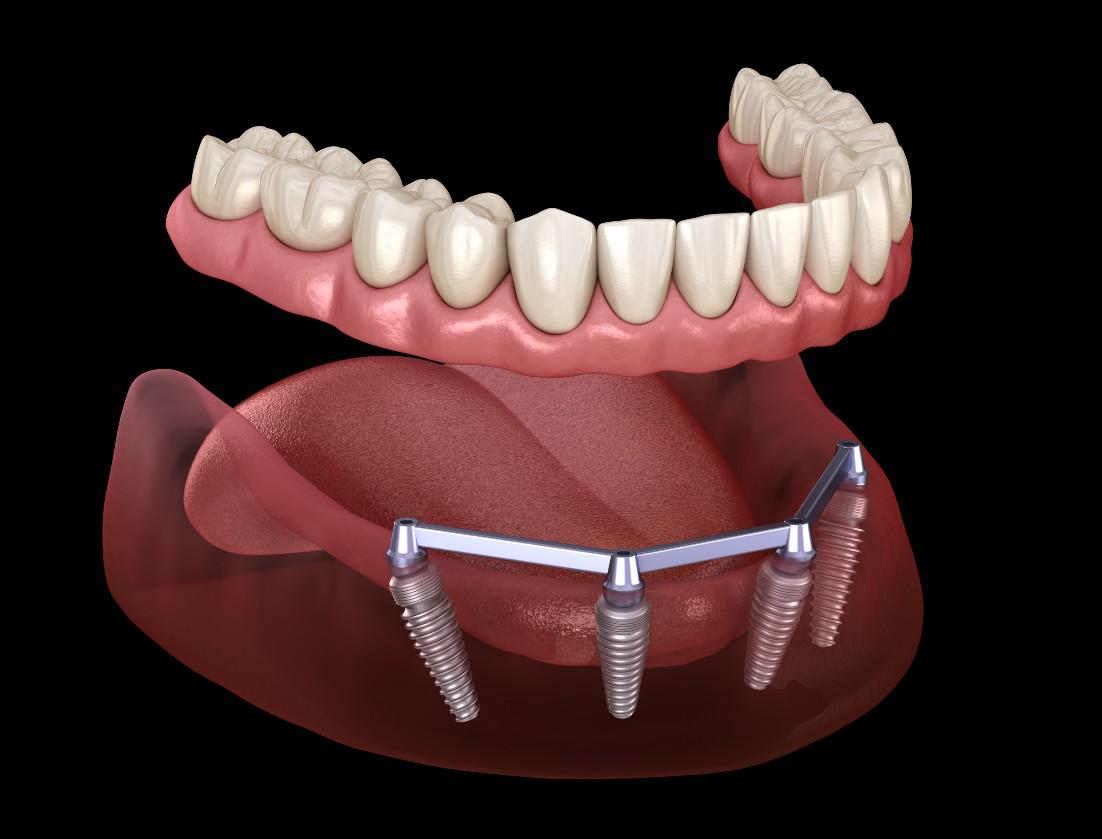 Dentures Oklahoma City, OK