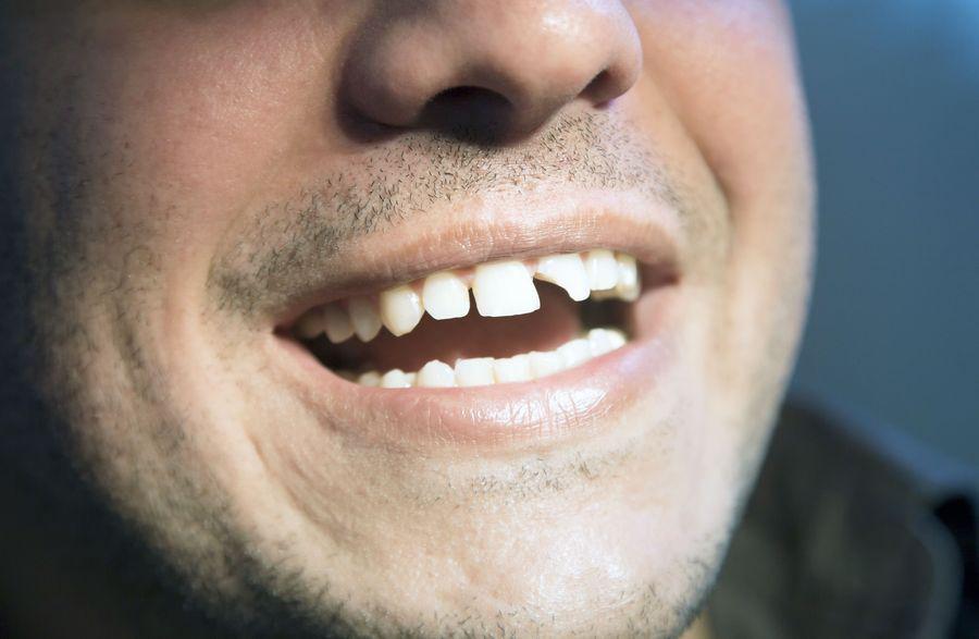 Dental bonding can be sculpted to conceal chips, breaks, and dental stains that detract from your smile.
